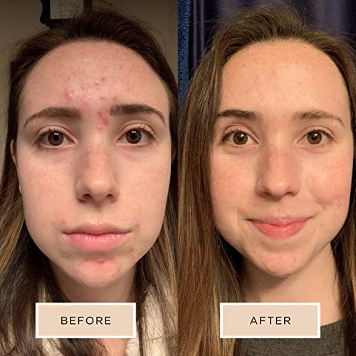 Averr Aglow Clear Skin Kit, Acne Treatment Kit, Face Skin Care, Breakouts Black Spot Remover, Natural Solution 4PC, Control Blemishes & Redness, All Natural Face Care Solution Set