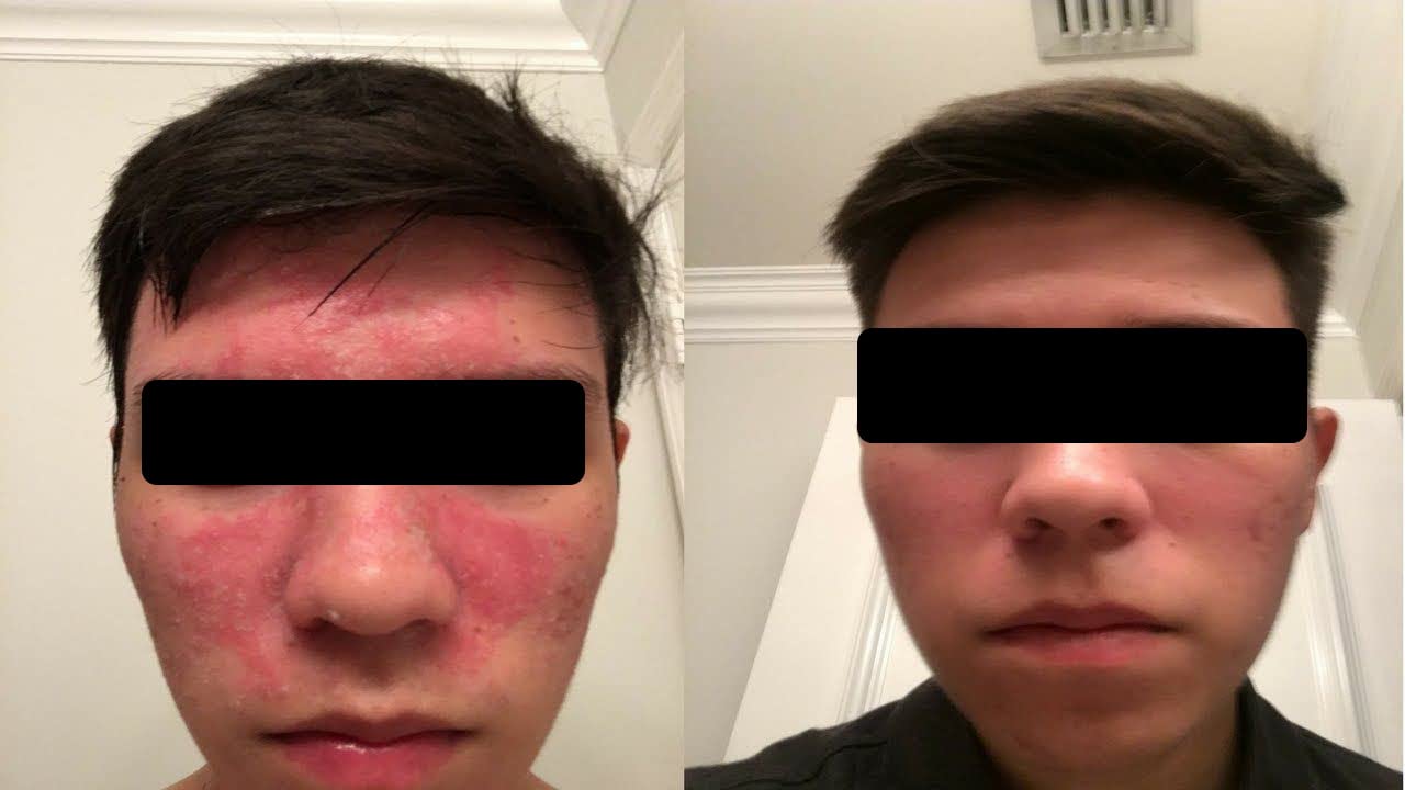 Dermgentle- Crema facial seborreica: alivia la dermatitis seborreica con aceite MCT y escualano: crema facial hidratante