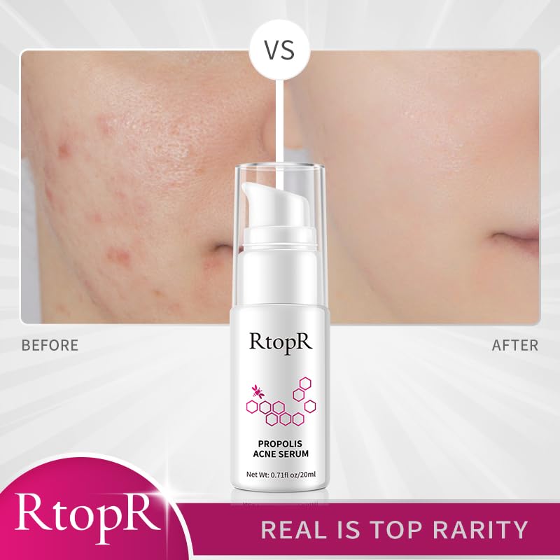 RtopR Propolis Repair Acne Serum, Suero Hidratante Anti-Acné para Eliminar el Acné Severo, Brotes, Granos y Reparar la Piel