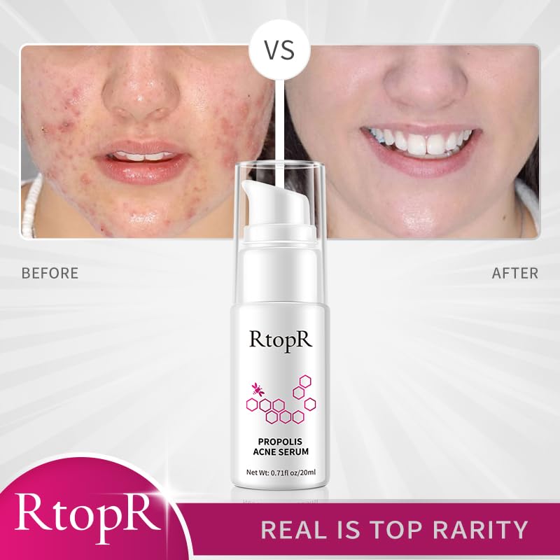 RtopR Propolis Repair Acne Serum, Suero Hidratante Anti-Acné para Eliminar el Acné Severo, Brotes, Granos y Reparar la Piel