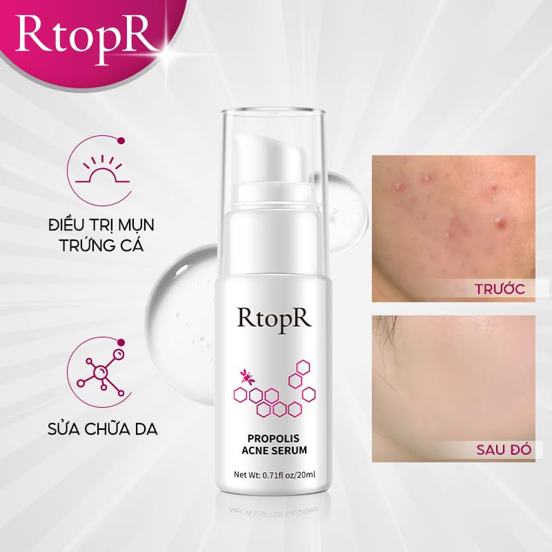RtopR Propolis Repair Acne Serum, Suero Hidratante Anti-Acné para Eliminar el Acné Severo, Brotes, Granos y Reparar la Piel