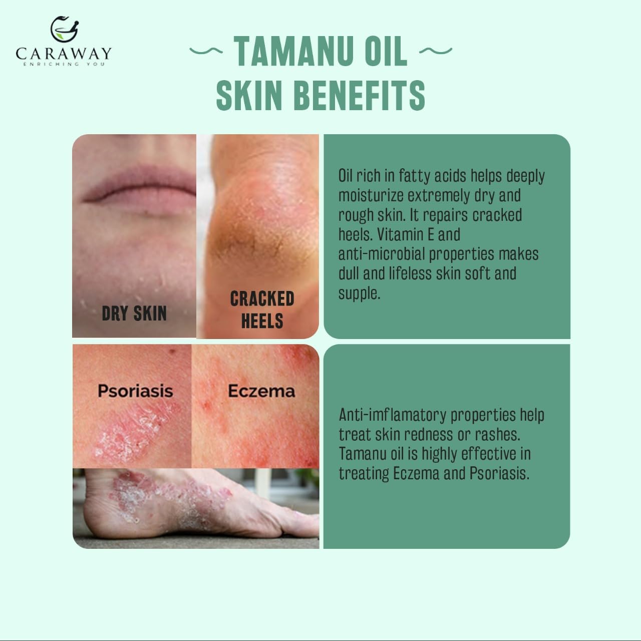 CARAWAY Tamanu Oil Organic for Skin – Ayurvedic Extraction Method Helps Treat Psoriasis, Eczema, Acne Scar, Rosacea – 1.7 Fl oz – 50 ml – Indian Origin