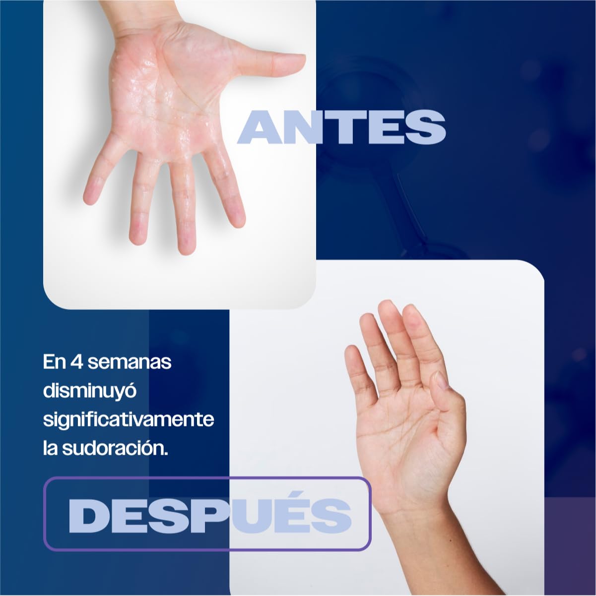 SKINDRY Sensitive Desodorante Mujer y Hombre para Pieles Sensibles | Sudoración Excesiva | 48 hrs de Protección | Antitranspirante Natural para Axilas, Pies, Manos, Espalda, Cuero Cabelludo | 35 ml