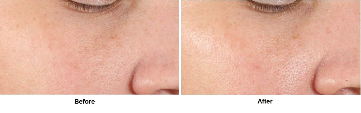 Sérum Alfa Beta para Perfeccionar y Refinar poros - Tratamiento facial profesional para reducir medidas y mejorar la apariencia de la piel. Apto para todo tipo de piel.