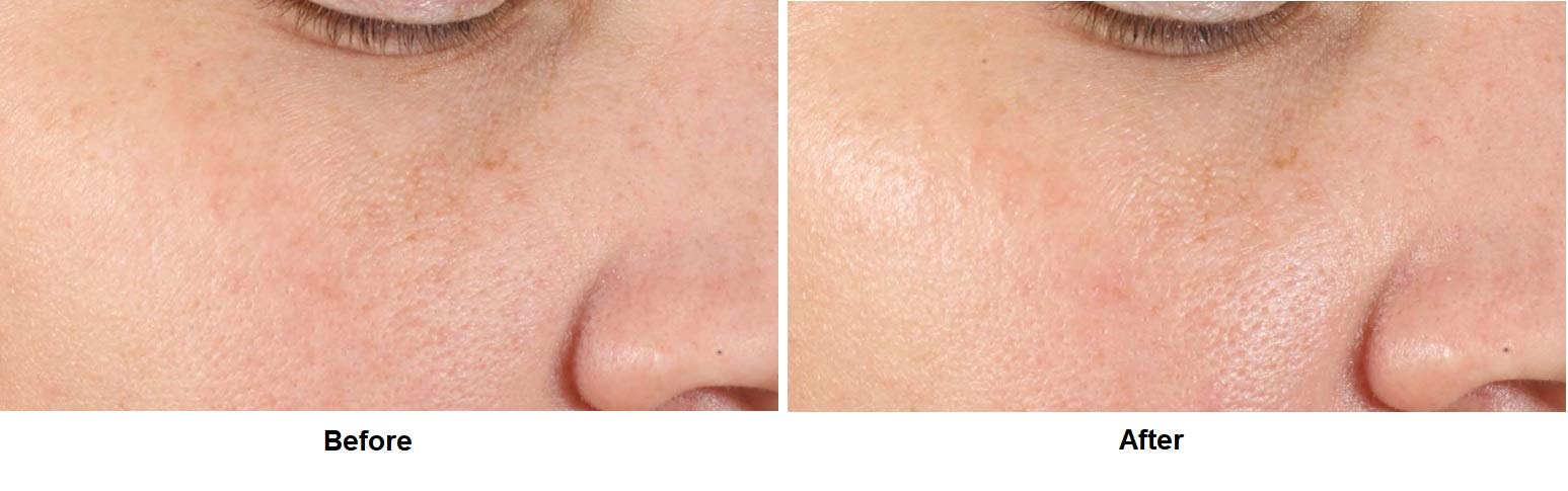 Sérum Facial Profesional Alfa Beta para Perfeccionar y Refinar poros