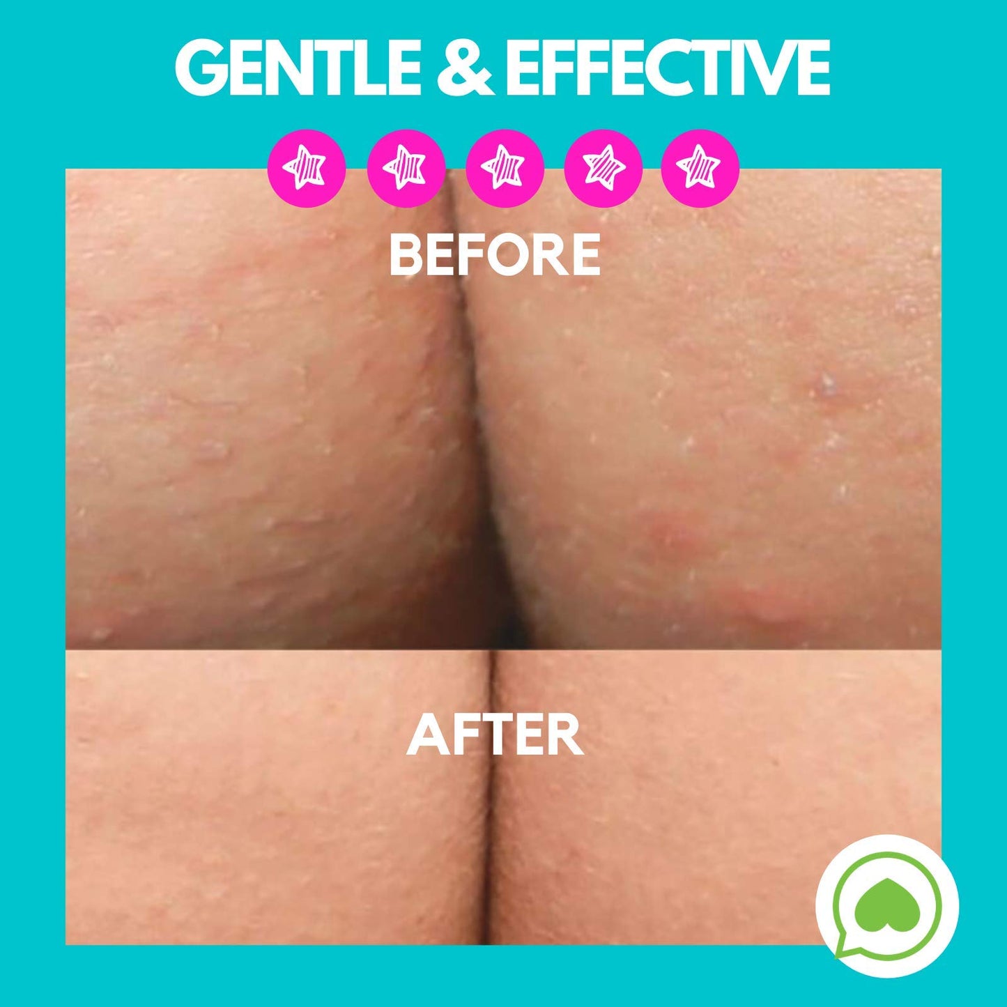 Brilliant Booty Kit | Butt Acne Clearing Lotion and ExfoliMATE Magic Body Exfoliating Cloth for Soft & Young Skin (Purple) by Green Heart Labs
