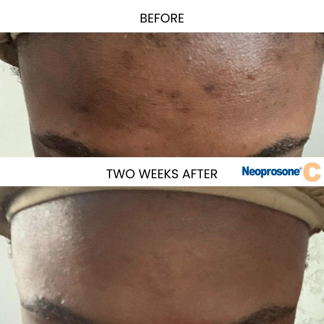 Crema Despigmentante Neoprosone Beige para Manchas Oscuras Corporal y Facial