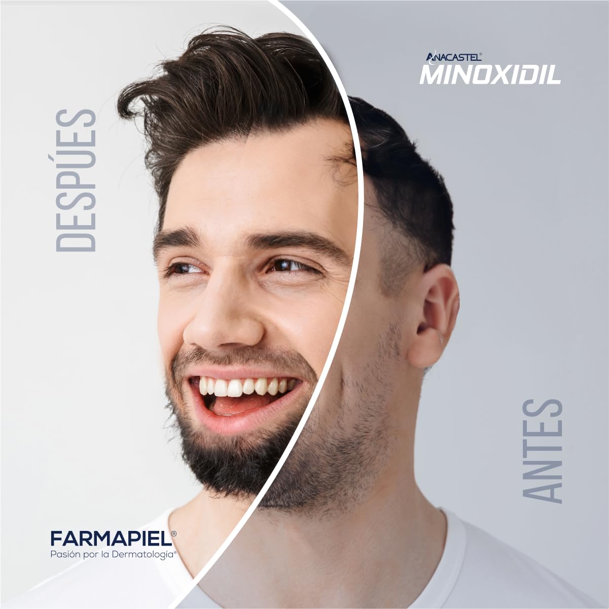 Minoxidil 5% Anacastel | Tratamiento Anticaída Cabello y Barba | Estimula Crecimiento Capilar | Hombres y Mujeres | Formato Spray | Pack 6 Unidades