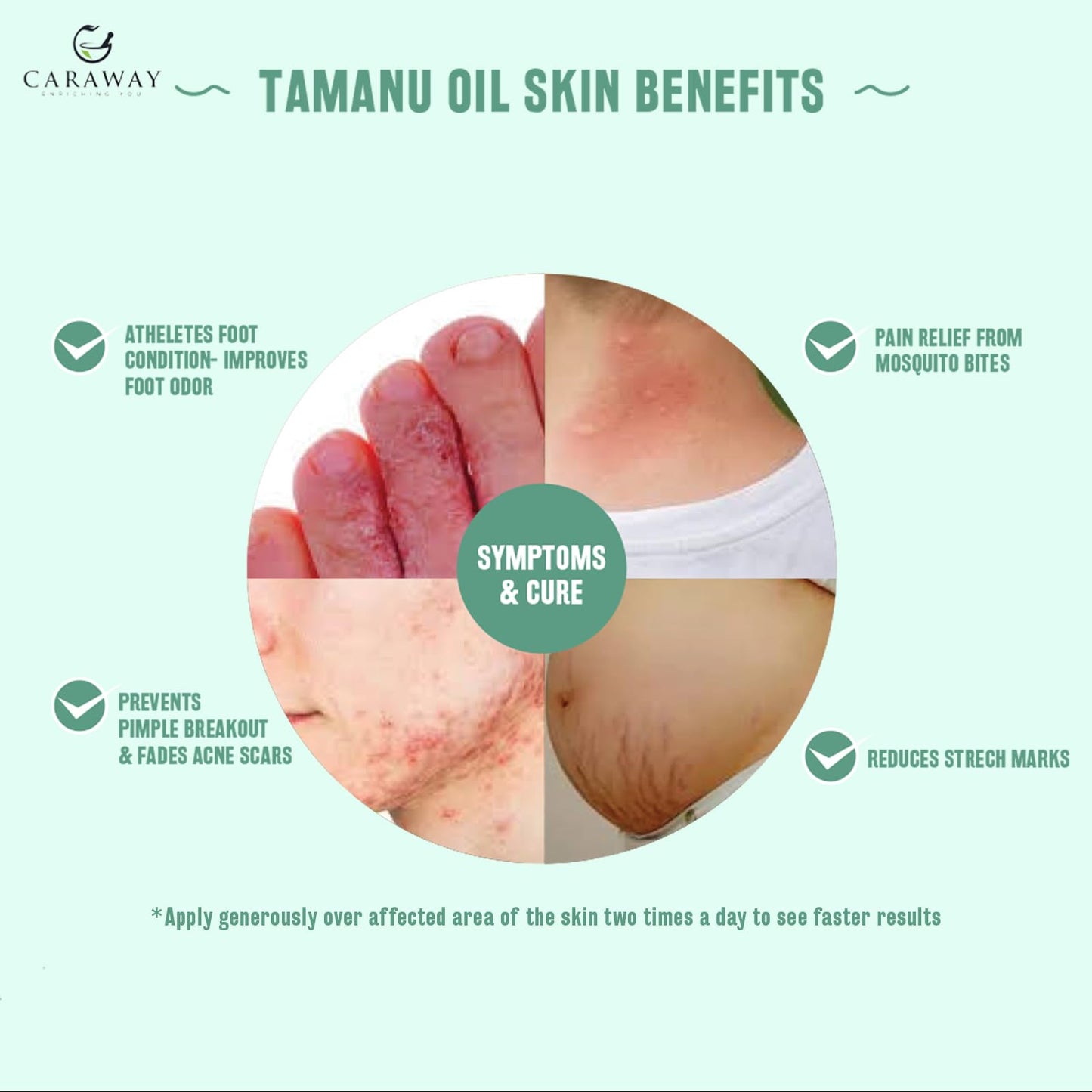 CARAWAY Tamanu Oil Organic for Skin – Ayurvedic Extraction Method Helps Treat Psoriasis, Eczema, Acne Scar, Rosacea – 1.7 Fl oz – 50 ml – Indian Origin