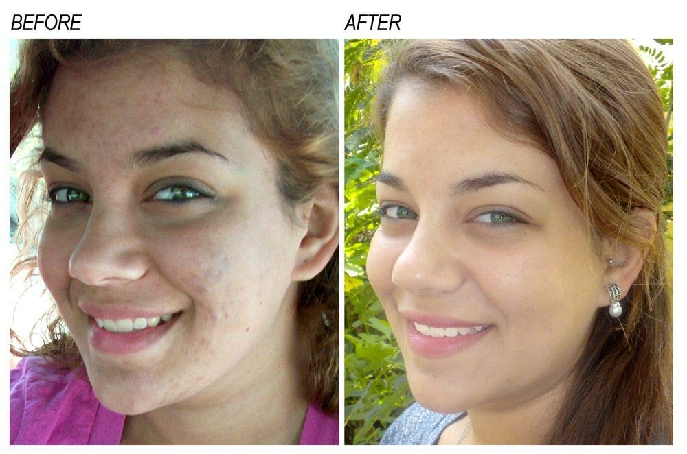 Crema Despigmentante Neoprosone Beige para Manchas Oscuras Corporal y Facial