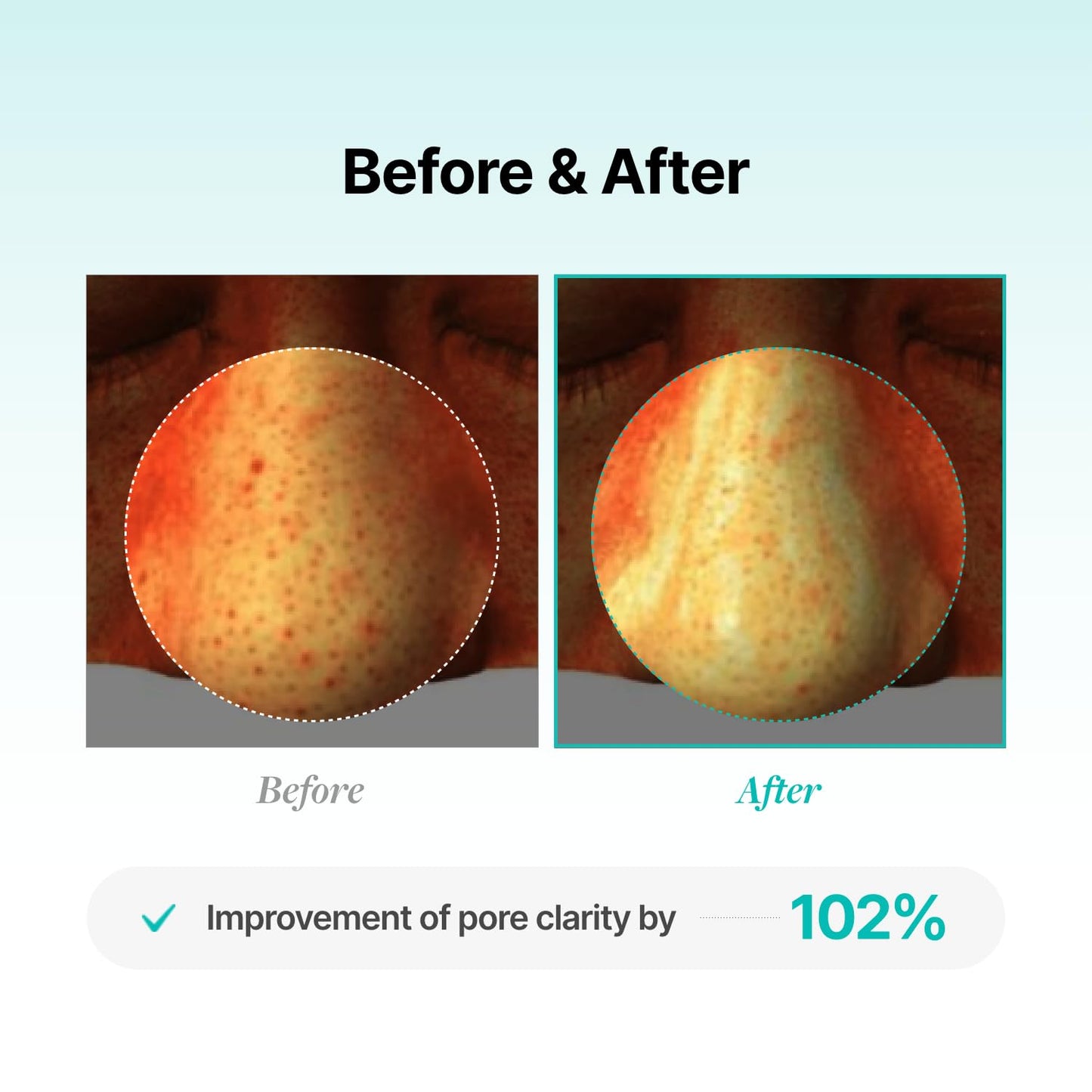 MEDITHERAPY Suero En Polvo De Bífida Real Porethera - Suero Facial Coreano Para Estiramiento De Poros - Minimizador De Poros Para La Cara Con Polvo Probiótico Para El Equilibrio De La Piel - Mejora La