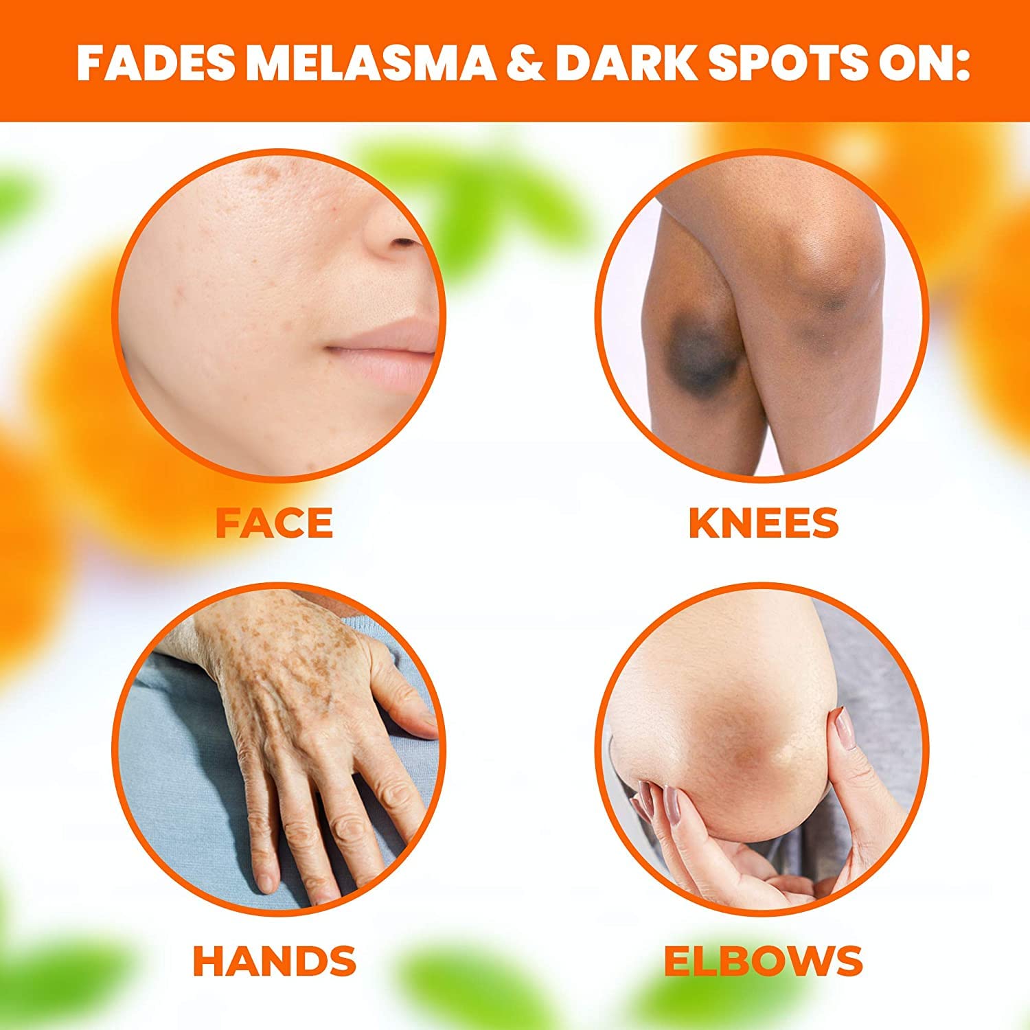 Crema Despigmentante Neoprosone Beige para Manchas Oscuras Corporal y Facial