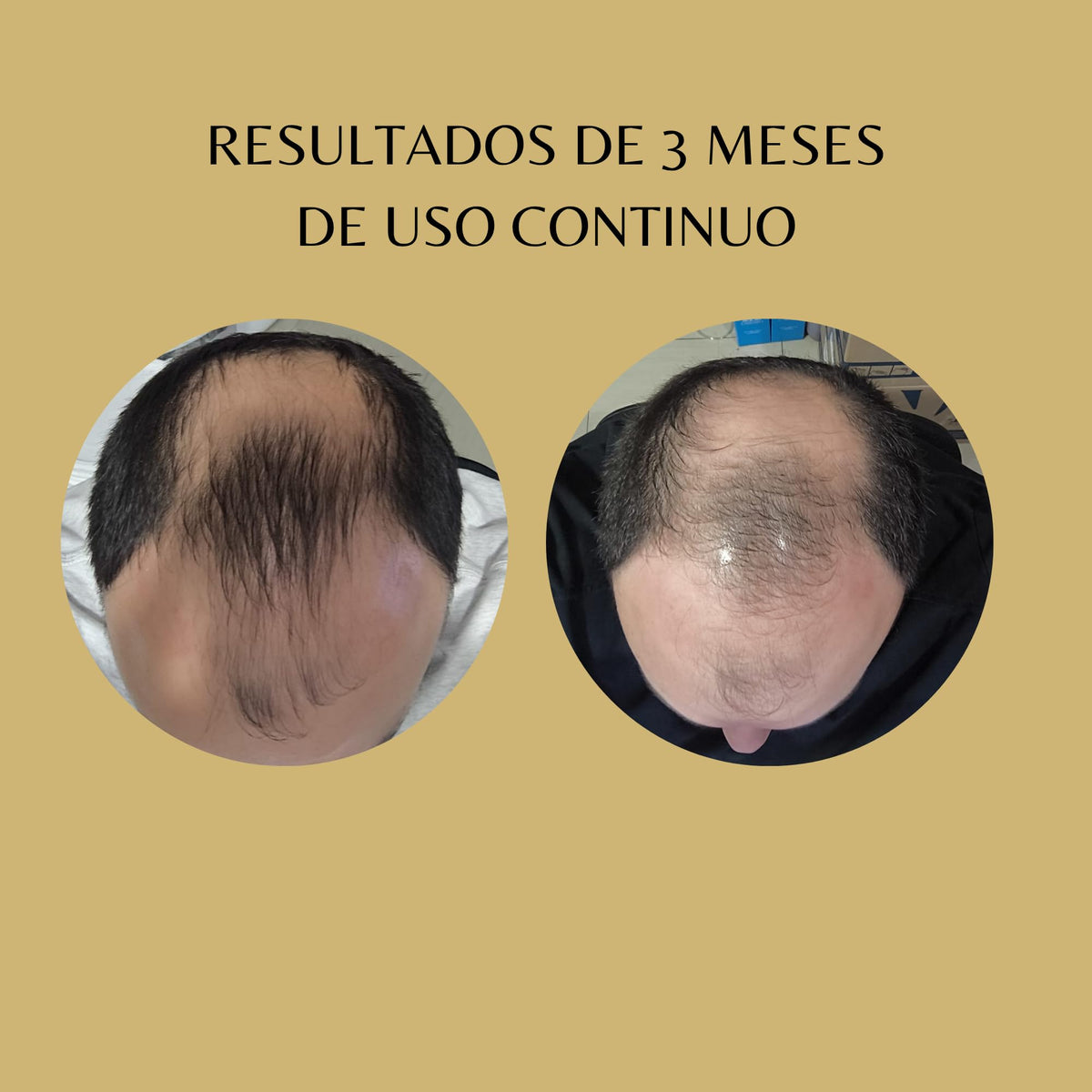Champú Dolce Piel Minoxidil 5% Estimulante Crecimiento y Densidad Cabello sin Sulfatos ni Parabenos para Alopecia Androgenética