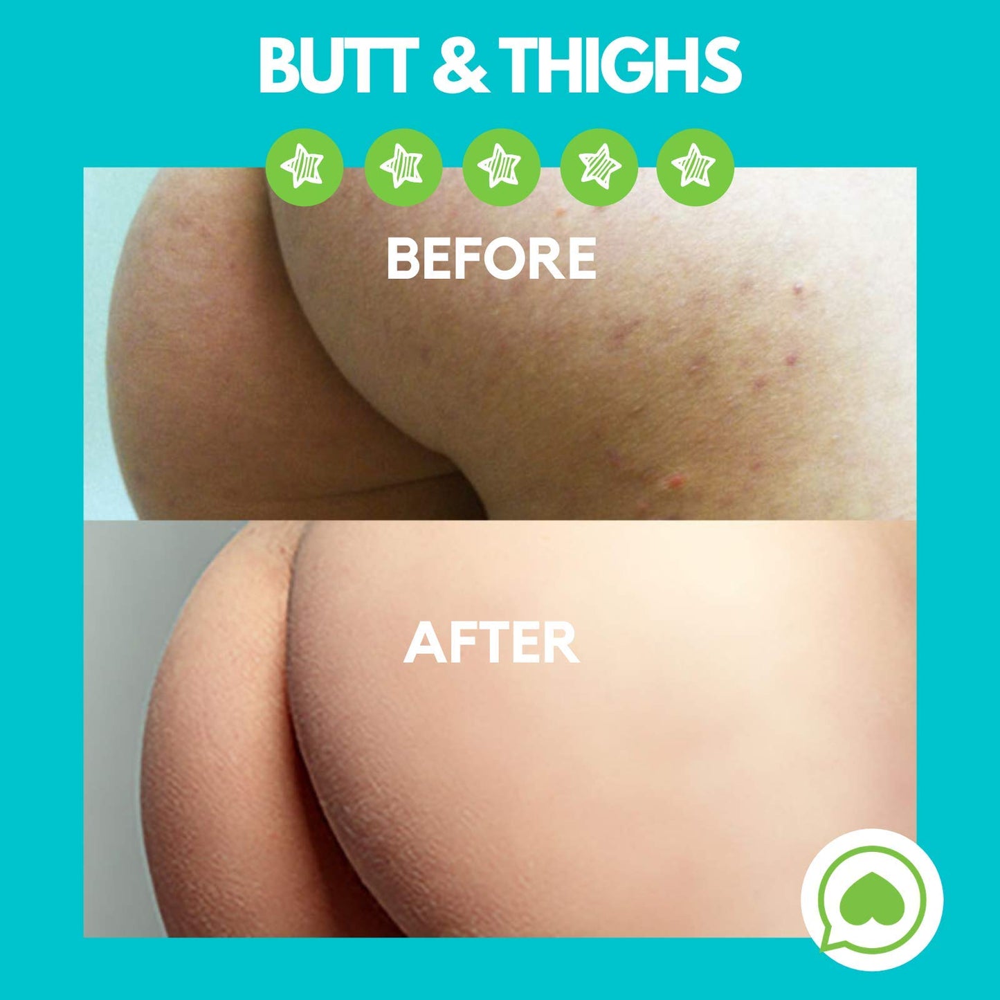 Brilliant Booty Kit | Butt Acne Clearing Lotion and ExfoliMATE Magic Body Exfoliating Cloth for Soft & Young Skin (Purple) by Green Heart Labs