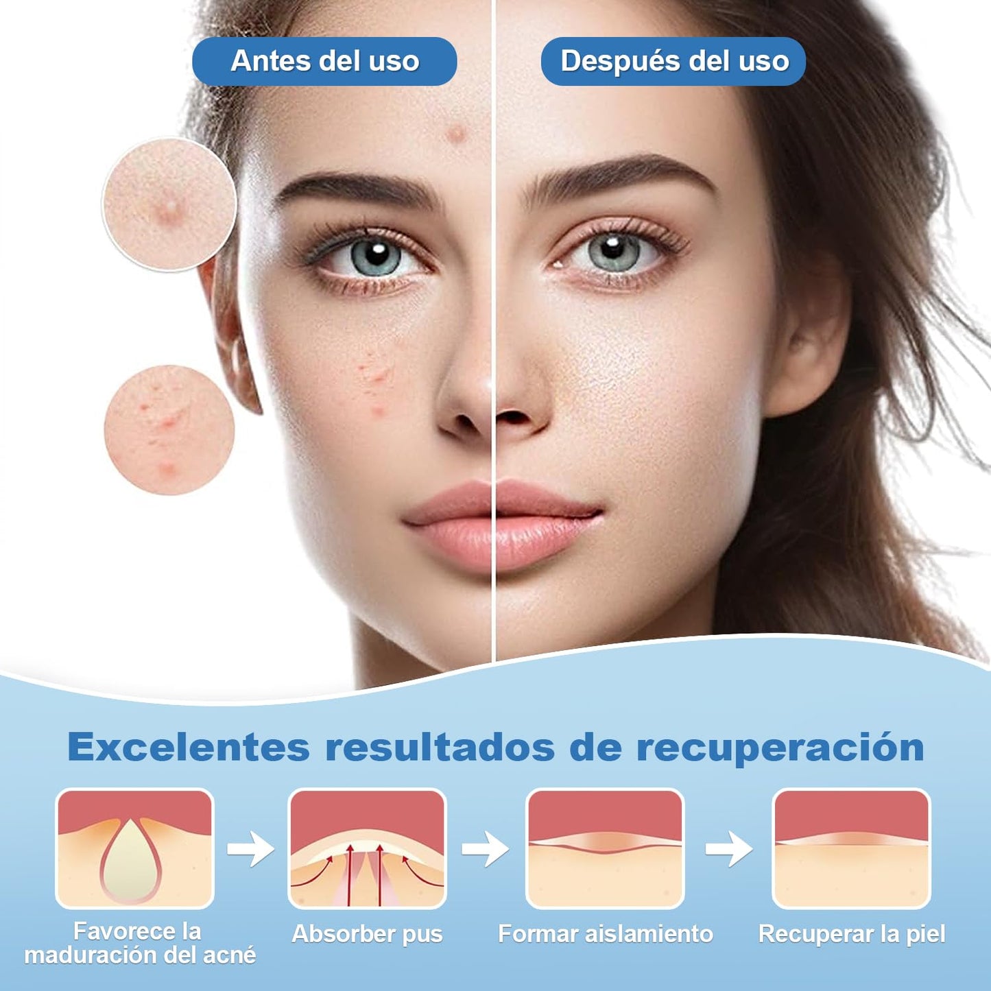 Parches para Acne,Pimple Patch,200 Almohadillas Hidrocoloides para Espinillas, Parches para Espinillas, Pimple Reduce Enrojecimiento,Forma de Estrella, Pueden Absorber la Secreción (Rojo)