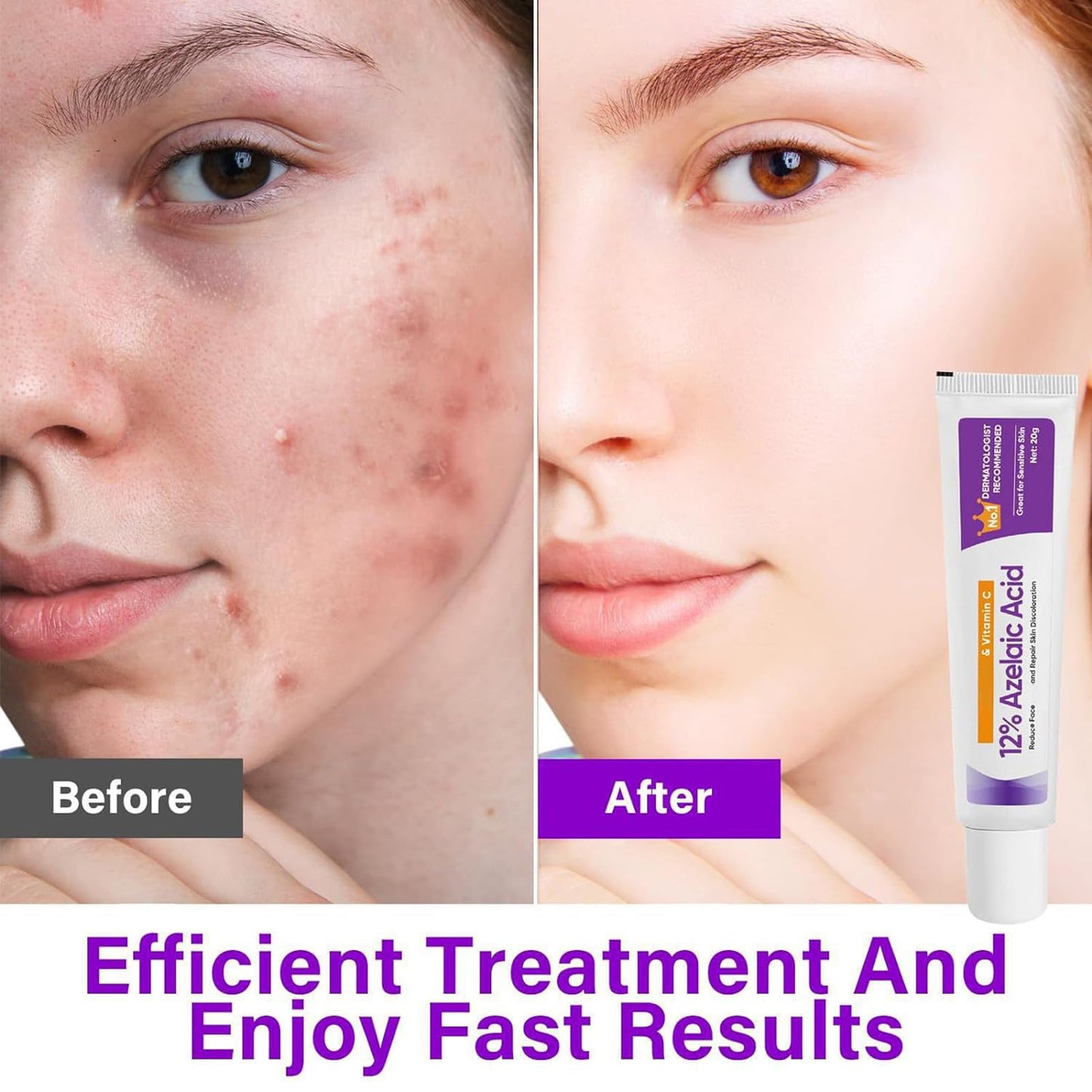 Suero Ácido Azelaico, Crema Ácido Azelaico, Suero Facial Ácido Azelaico 12% Contra Rojeces, Anti Granos y Nódulos, Suero Facial Ácido Azelaico Ácido Hialurónico para Piel Sensible, 20g (3)