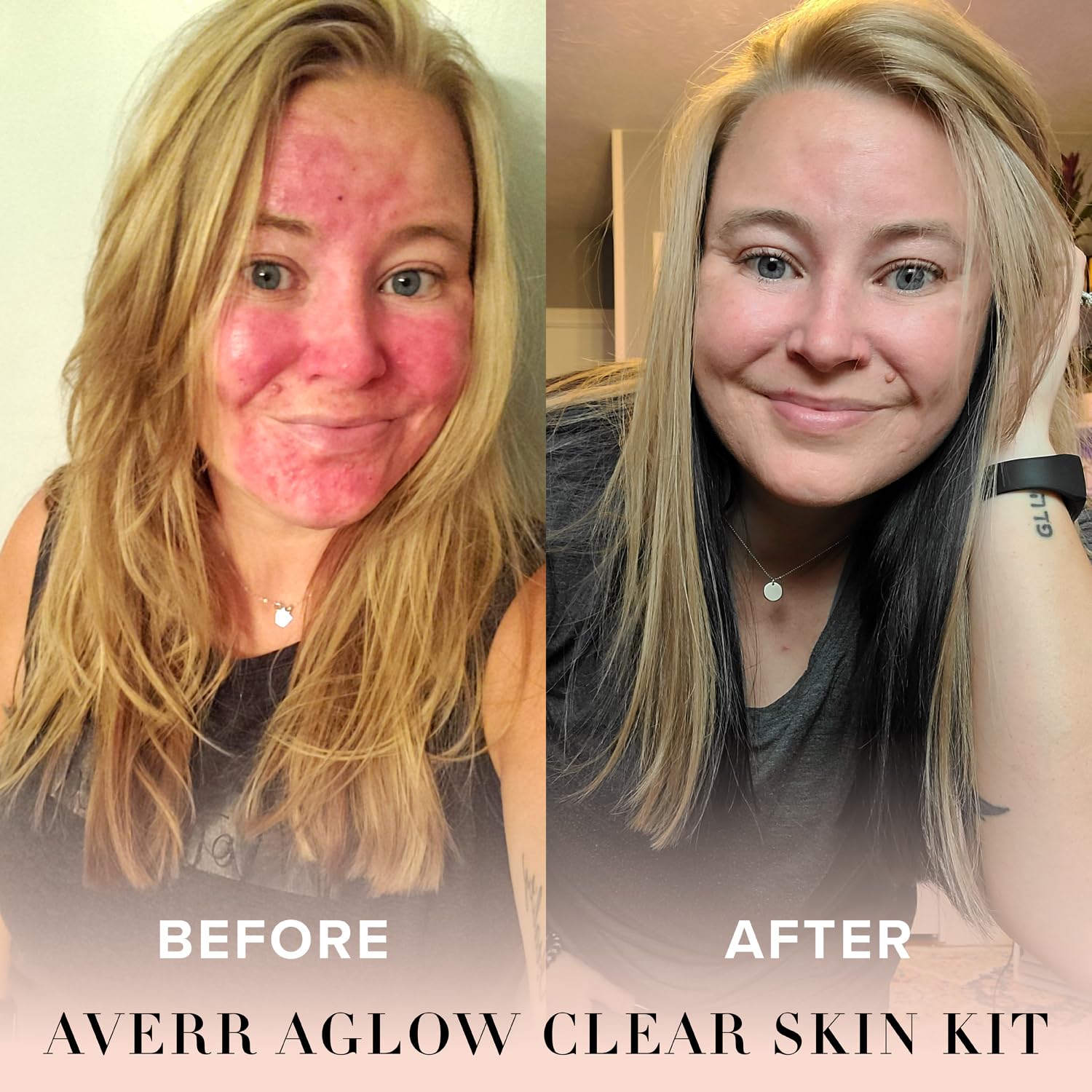 Averr Aglow Clear Skin Kit, Acne Treatment Kit, Face Skin Care, Breakouts Black Spot Remover, Natural Solution 4PC, Control Blemishes & Redness, All Natural Face Care Solution Set