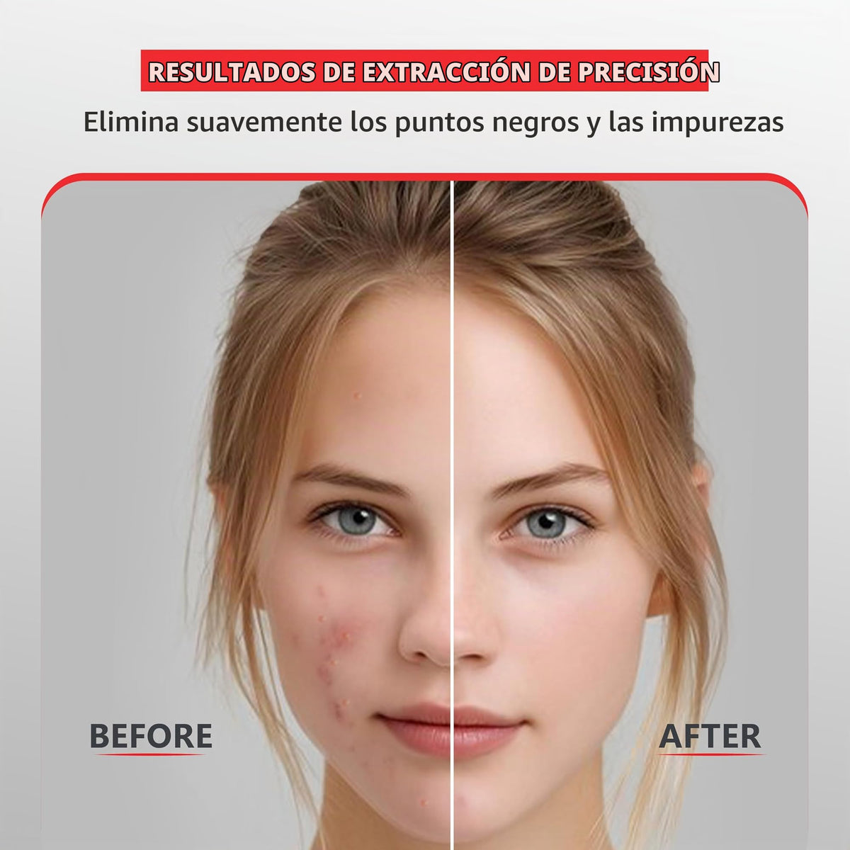 Herramienta para eliminar milia Suvorna Skinpal, removedor de granos, extractor para granos, puntos negros, puntos blancos, comedones, acné, espinillas, imperfecciones, quistes y manchas.