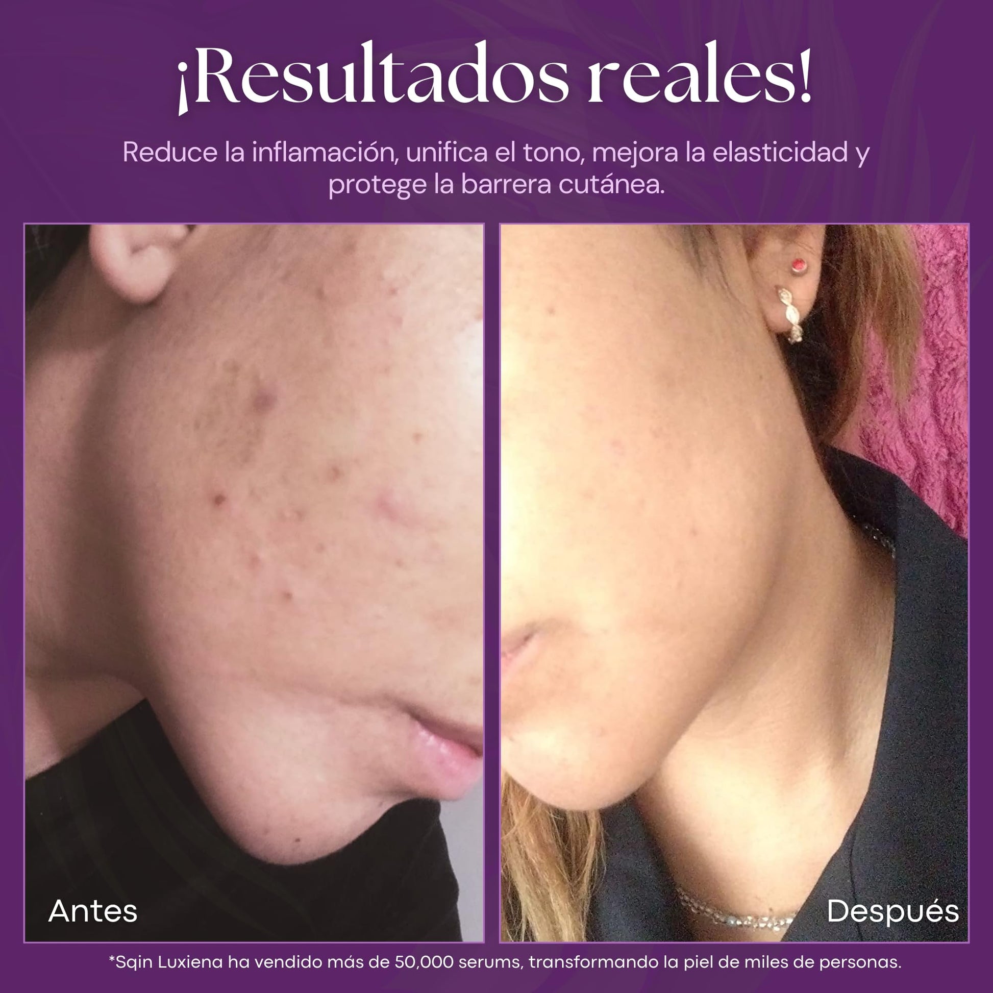 Sqin Luxiena Korean Serum de Niacinamida, Vitamina E y Ácido Hialurónico Facial, Suero Facial Control Piel Grasa, Reduce Poros, Puntos Negros y Mejora la Textura, Coreano Skincare Vegano 32 ml.