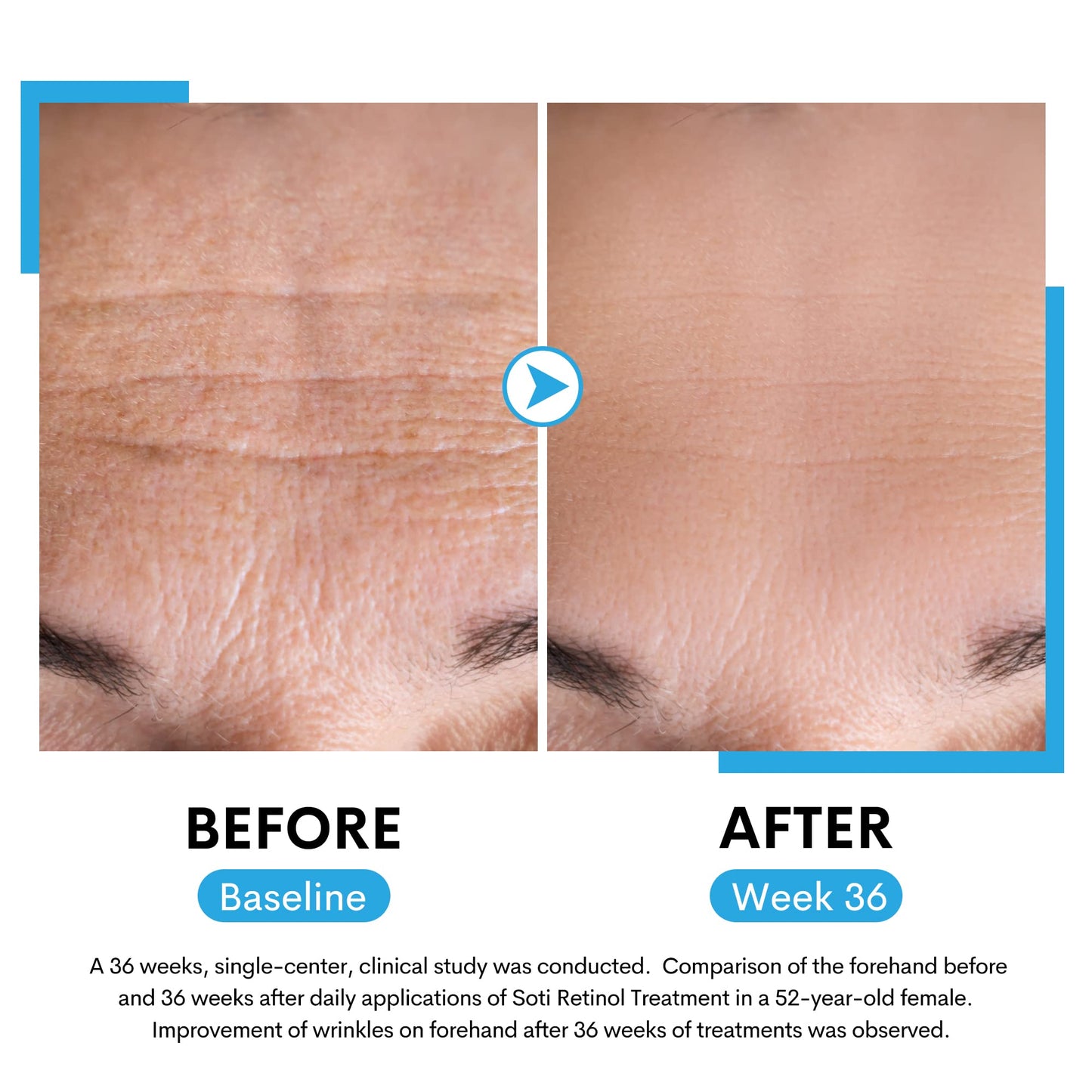 Sérum de Retinol 2.5% Soti USA Rojo Antiedad con Ácido Hialurónico y Niacinamida 30ml