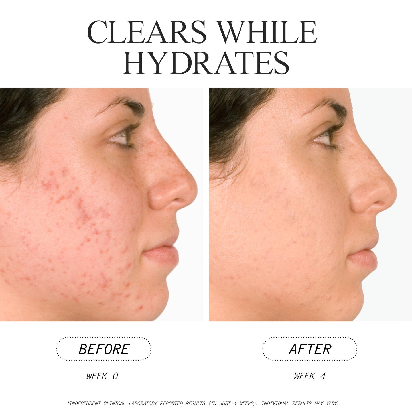Juice Beauty Blemish Clear Serum con ácido salicílico y corteza de sauce, 2 onzas líquidas