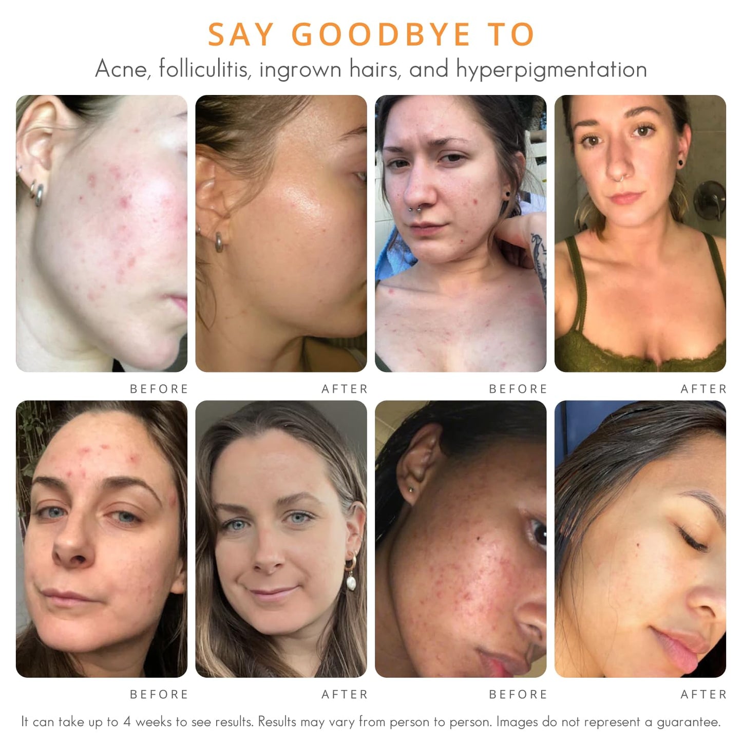 NEW! Body Clearing Serum - for body acne, folliculitis, ingrown hairs, dark spots - butt, chest, back, thighs, shoulders - mandelic acid - naturally antibacterial/antifungal | by AlmondClear