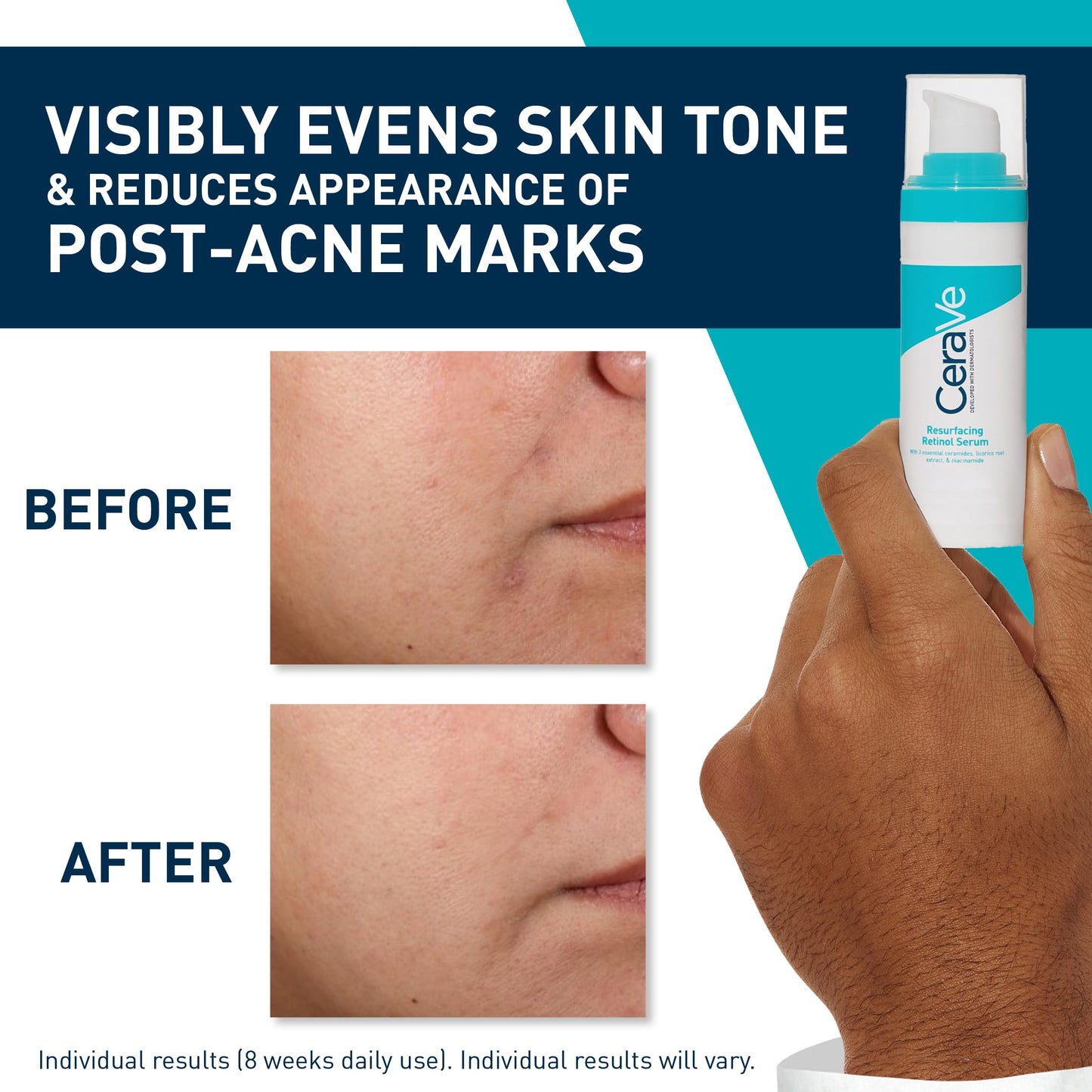 Cerave Serum Retinol Anti-Marcas Para Piel Grasa o Acne, 30ml