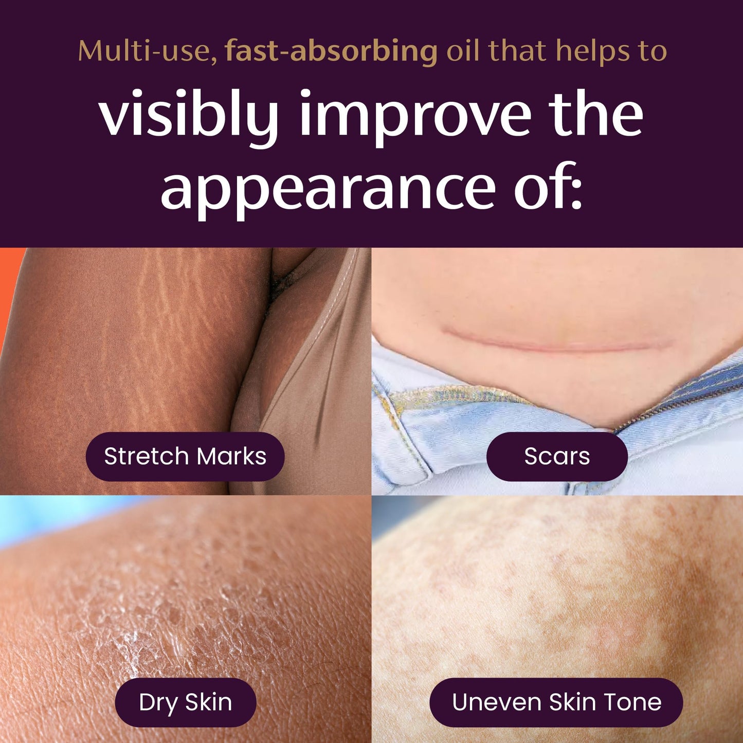 Mederma Quick Dry Oil, Scar and Stretch Mark Treatment, Helps to Improve the Appearance of Scars and Stretch Marks, with Natural Botanical Extracts, Paraben Free, Fast-Absorbing, 3.4oz (100ml)