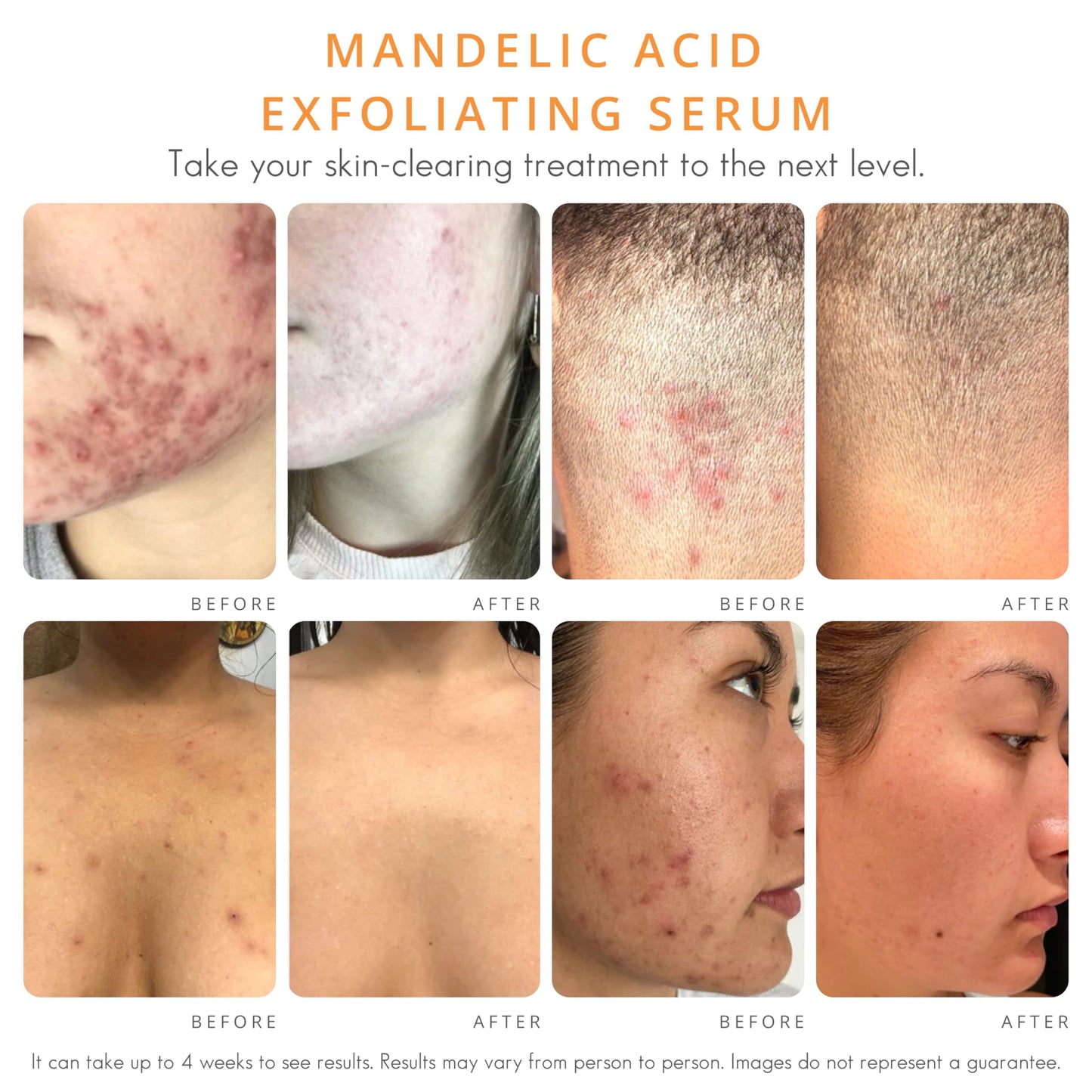 NEW! Body Clearing Serum - for body acne, folliculitis, ingrown hairs, dark spots - butt, chest, back, thighs, shoulders - mandelic acid - naturally antibacterial/antifungal | by AlmondClear