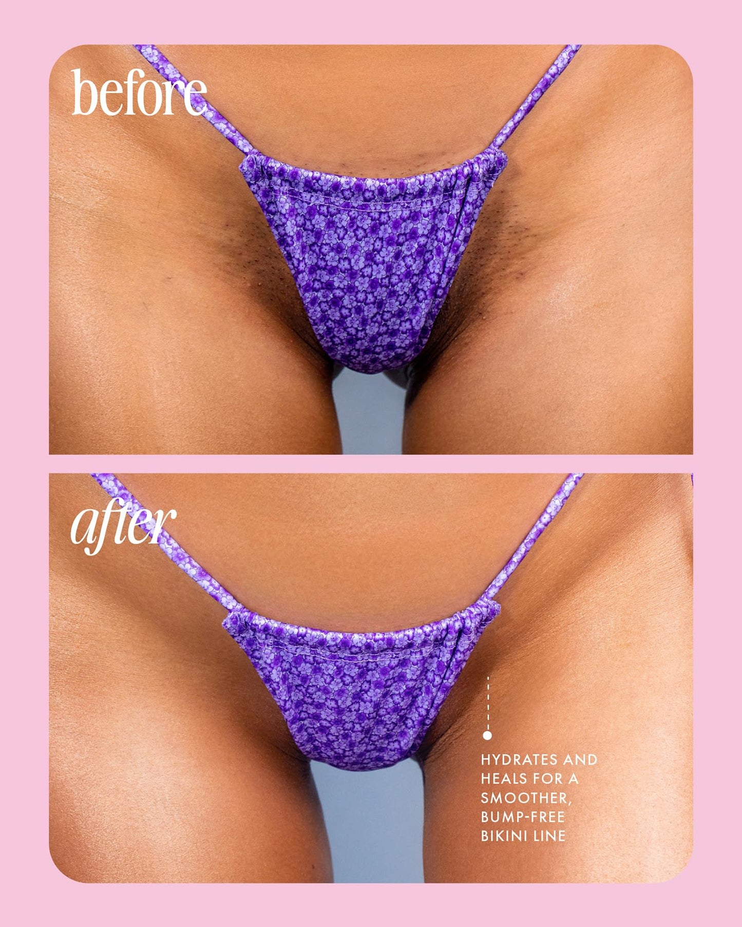 Truly Beauty Cooka Concentrado Suero Encarnado - Tratamiento Para El Cabello Encarnado Para El Área Del Bikini - Fórmula Suavizante Y Calmante Para Después Del Afeitado - Cura Quemaduras, Mellas Y Enc