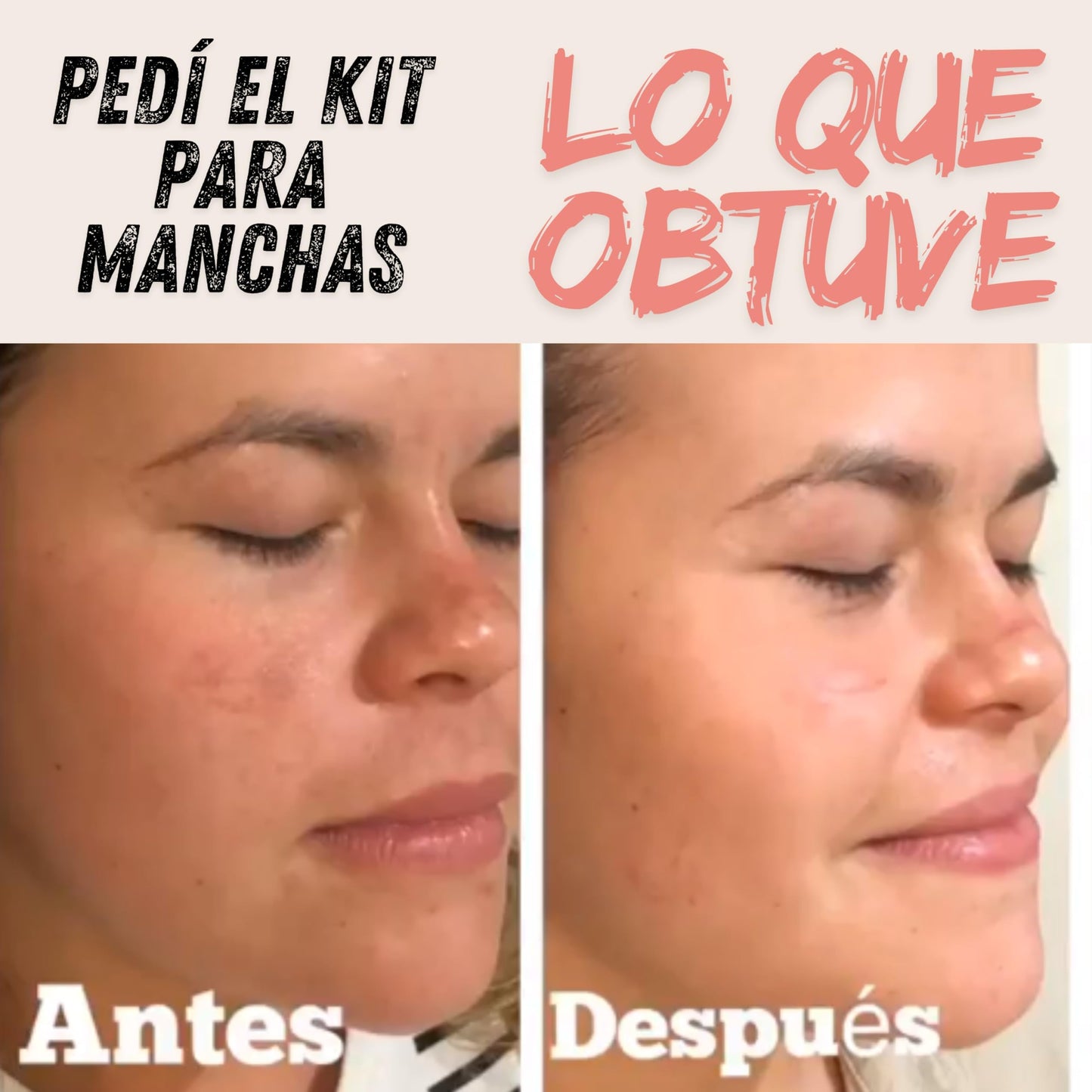 Kit para manchas faciales con crema despigmentante con 2% de hidroquinona, suero de vitamina C, suero de niacinamida, suero de ácido hialurónico, crema de día y limpiador facial | Tu Piel Dra Lietza |