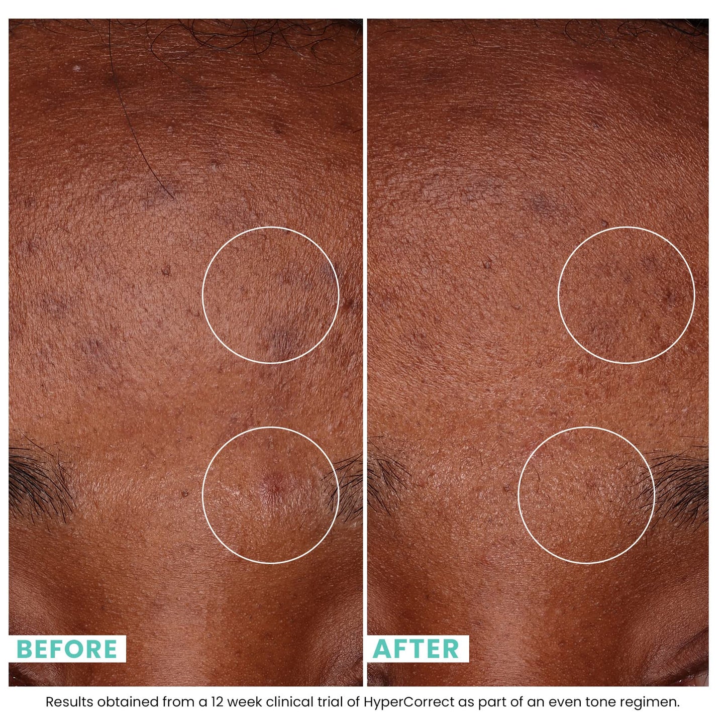 Urban Skin Rx- Crema aclarante HyperCorrect | 5% de cisteamina y 1% de niacinamida | Para cicatrices y tono de piel desigual, 1,7 fl.