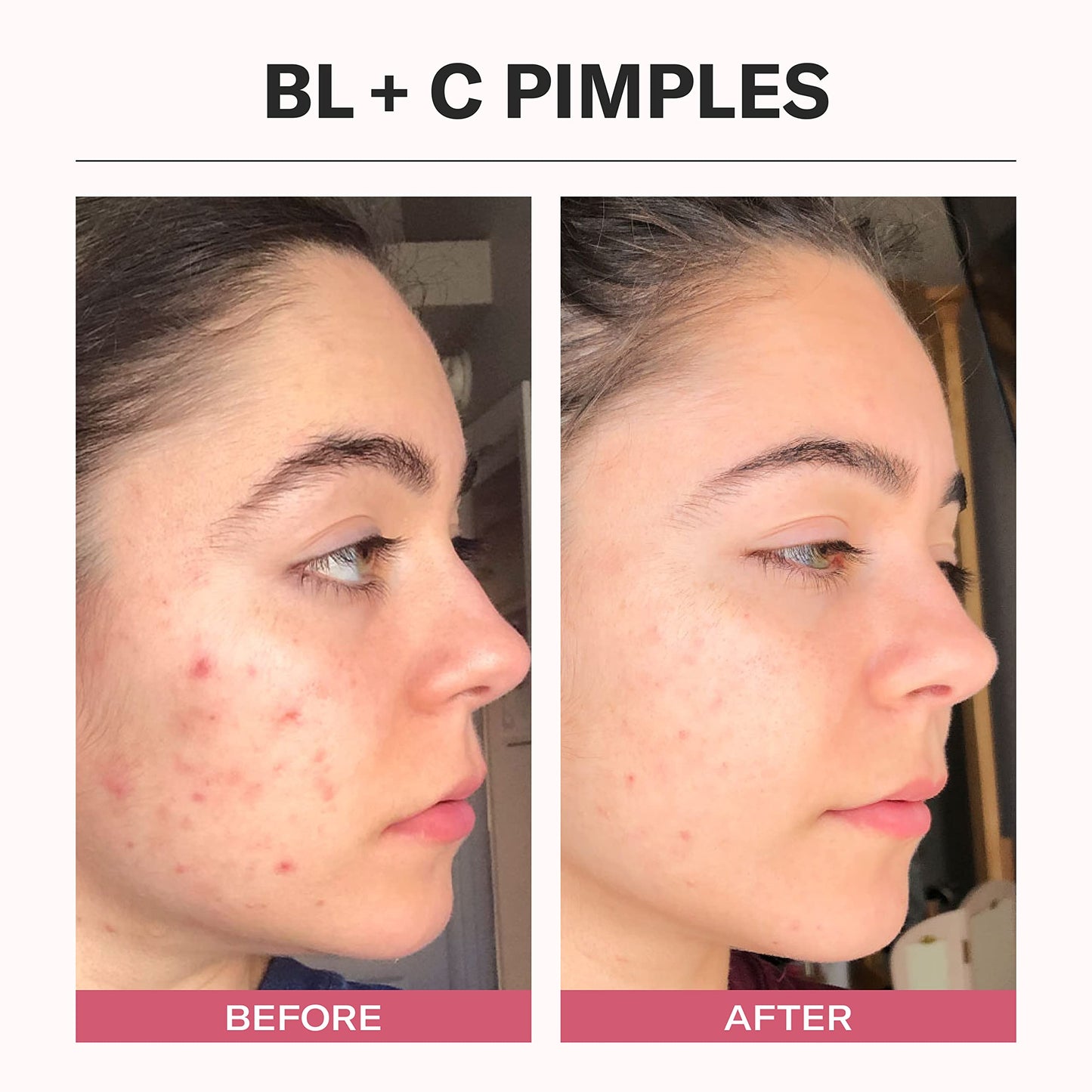 Odacità | Bl+C Pimples Facial Serum Concentrate | Black Cumin & Cajeput | Achieve Blemish-Free Skin | For Oily & Acne-Prone Skin | Natural, Vegan & Cruelty-Free | 5ml