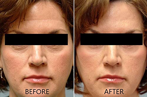 Dr. Brenner Suero de vitamina C 20% puro ácido L-ascórbico, ácido ferúlico, vitamina E y ácido hialurónico para cara y ojos, natural, antienvejecimiento, antiarrugas, 1 onza. por Dr. Brenner (1 onza)
