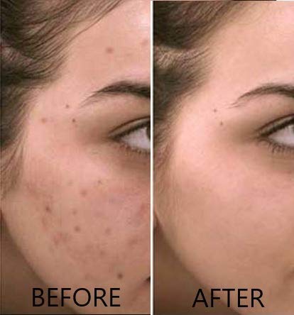 Dr. Brenner Suero de vitamina C 20% puro ácido L-ascórbico, ácido ferúlico, vitamina E y ácido hialurónico para cara y ojos, natural, antienvejecimiento, antiarrugas, 1 onza. por Dr. Brenner (1 onza)