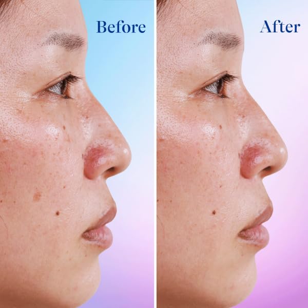 Dark Spot Correcting Face Serum by the makers of Differin Gel, Dark Spot Correcting Serum, Gentle Skin Care for Acne Prone Sensitive Skin, 1 oz