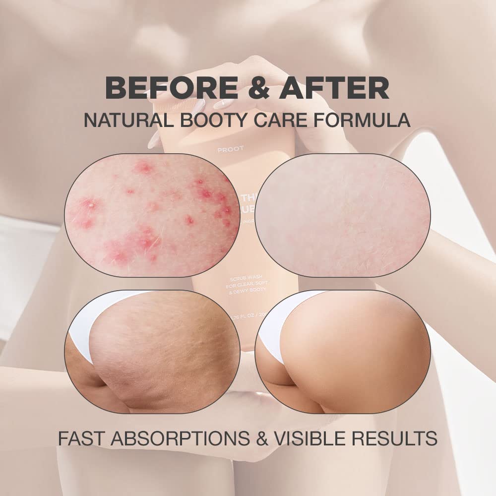 Lavado exfoliante de glúteos y muslos | Exfoliante para glúteos para acné, celulitis, cabello encarnado, bikini y bulto de maquinilla de afeitar | Exfoliante calmante y calmante para pieles sensibles y propensas al acné | Formulado con extracto de romero,