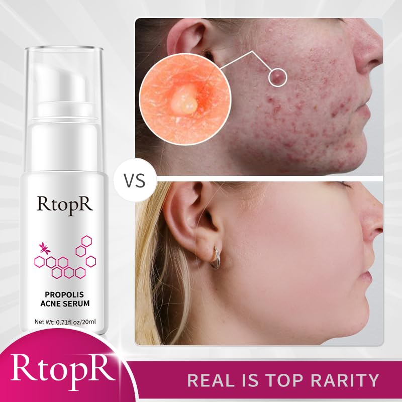 RtopR Propolis Repair Acne Serum, Suero Hidratante Anti-Acné para Eliminar el Acné Severo, Brotes, Granos y Reparar la Piel
