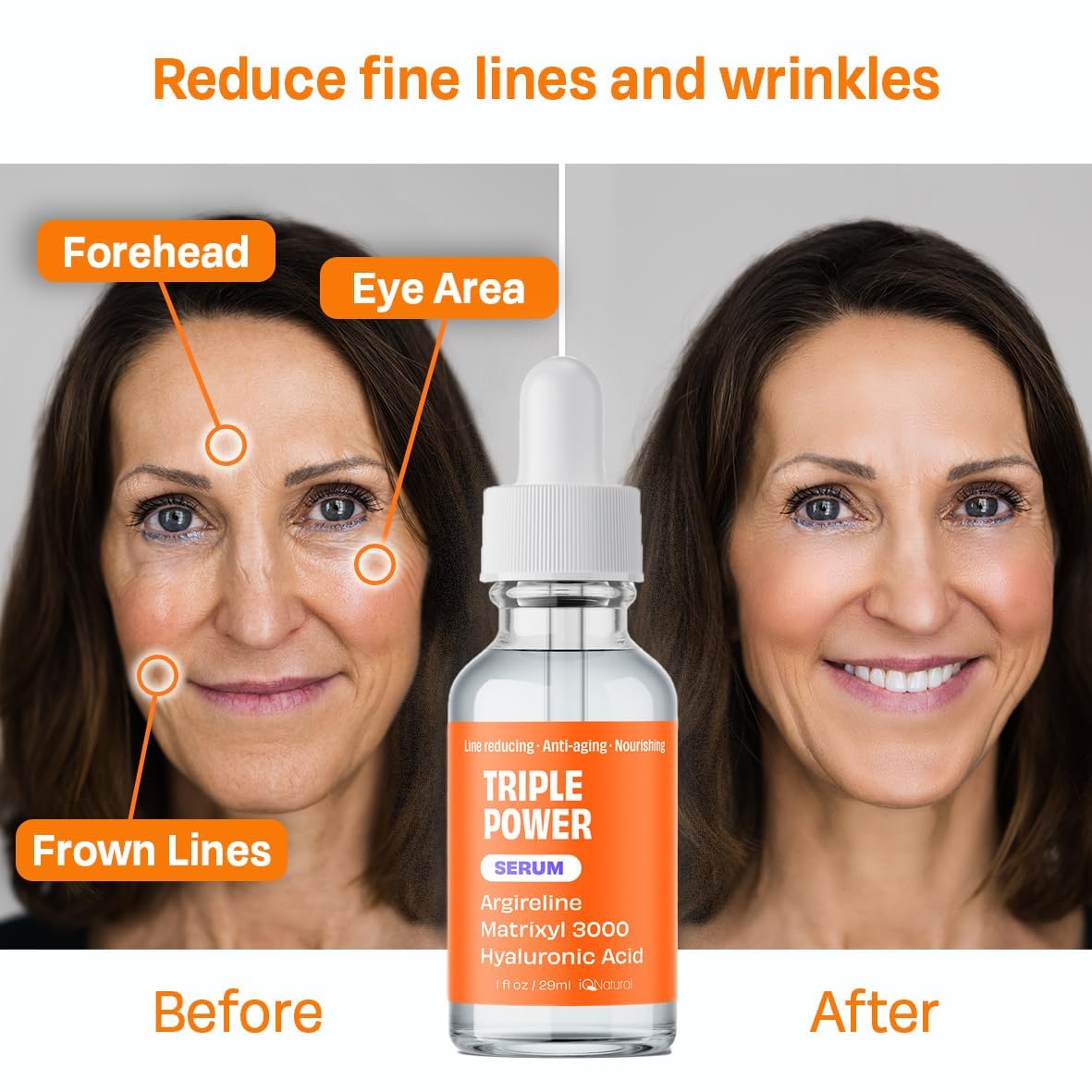 IQNATURAL Argireline Serum Hyaluronic Acid, Matrixyl 3000, Boost Collagen NO PAINFUL INJECTIONS! 1.0oz by IQ Natural