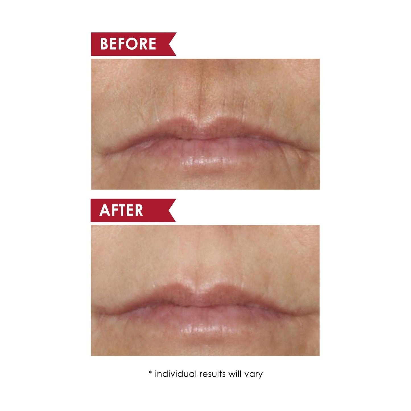 Dermelect Smooth Upper Lip & Perioral Anti-Aging Treatment - Professional Strength 15ml