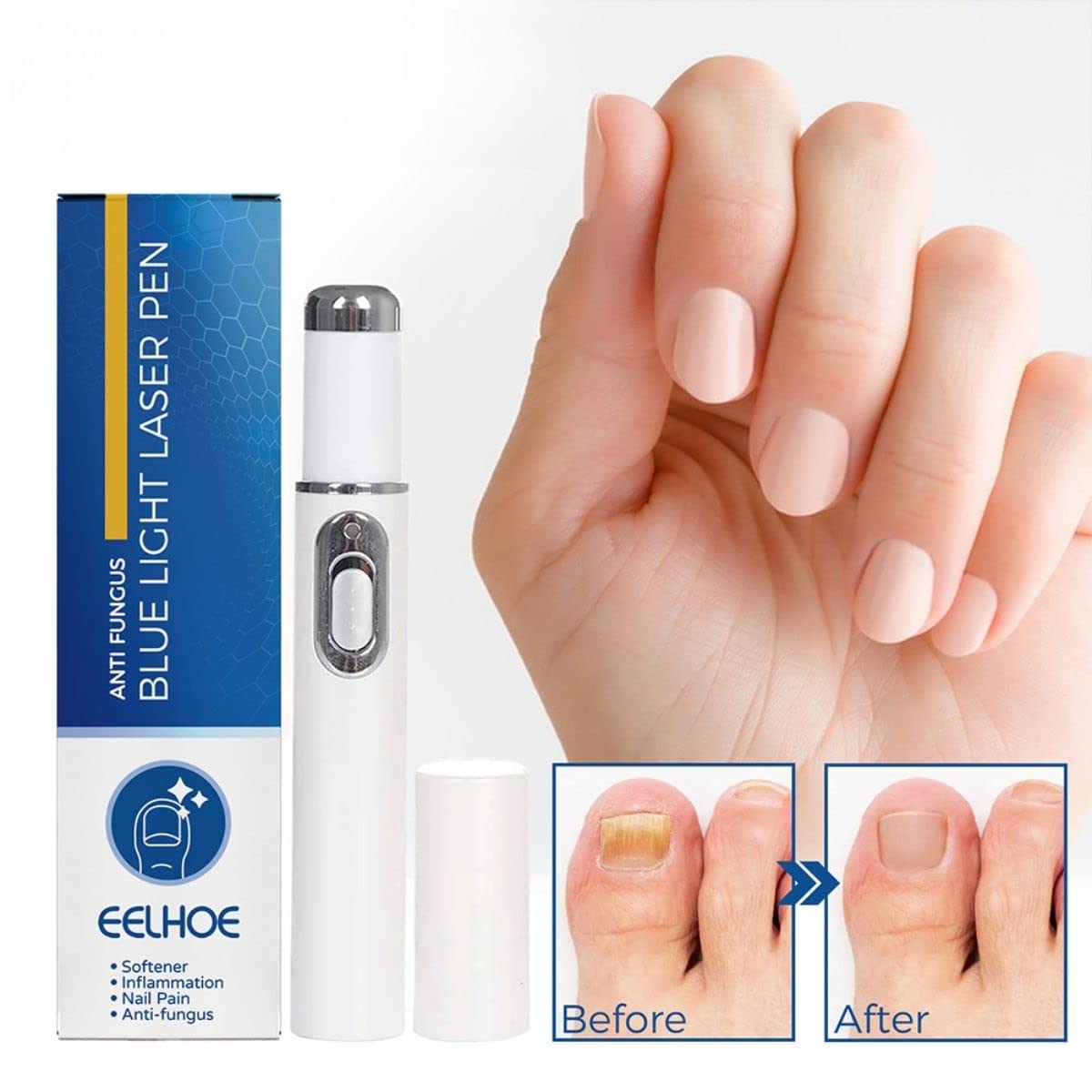 EELHOE Bolígrafo Luz Azul para Tratamiento de Hongos en Uñas - Elimina Onicomicosis y Paroniquia