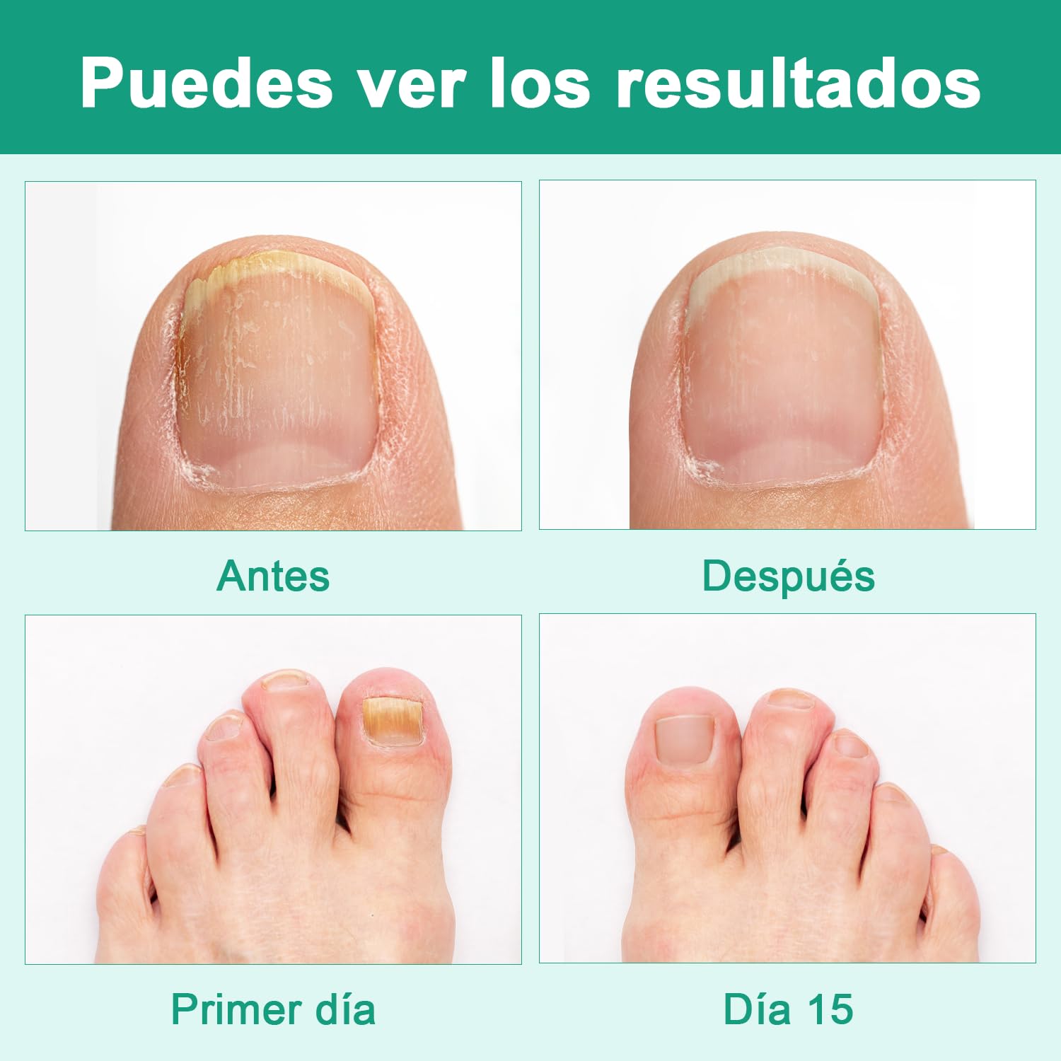 KRASSENTIALES Líquido Reparador Uñas de Pies - Esmalte, Renovación Cutículas