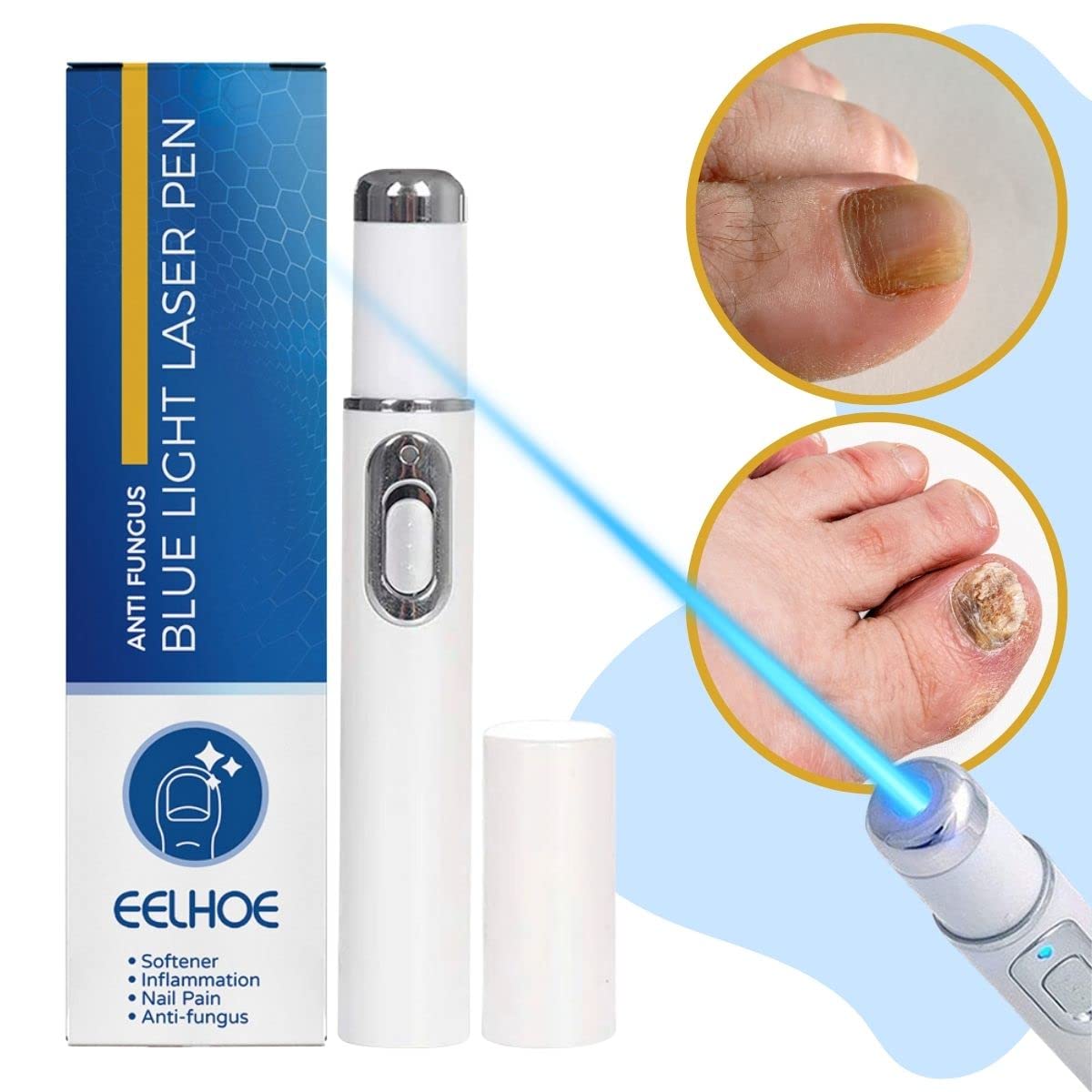 EELHOE Bolígrafo Luz Azul para Tratamiento de Hongos en Uñas - Elimina Onicomicosis y Paroniquia