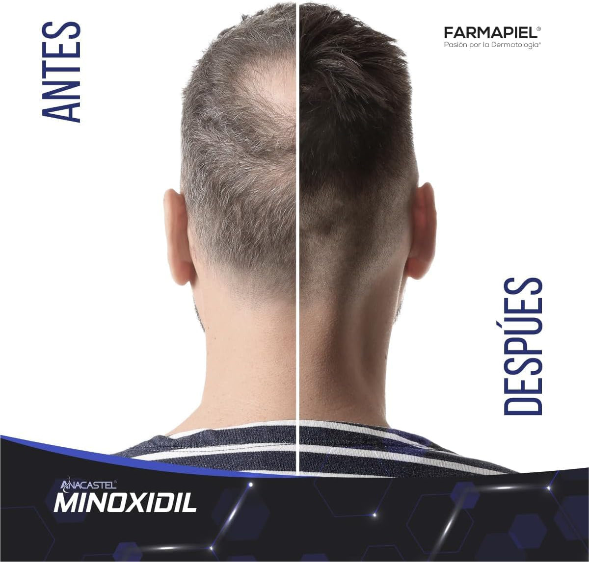 Kit Anticaída Anacastel Minoxidil 5% + Shampoo Alostêt