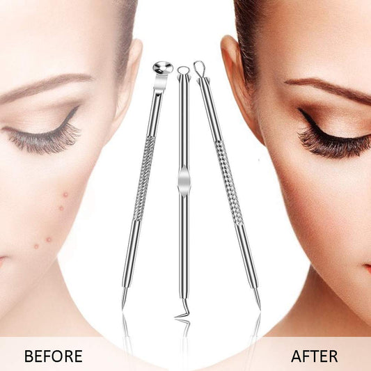 Kit Profesional USCOLOR Acero Inoxidable Extractor de Espinillas para Cara y Nariz 7 Piezas
