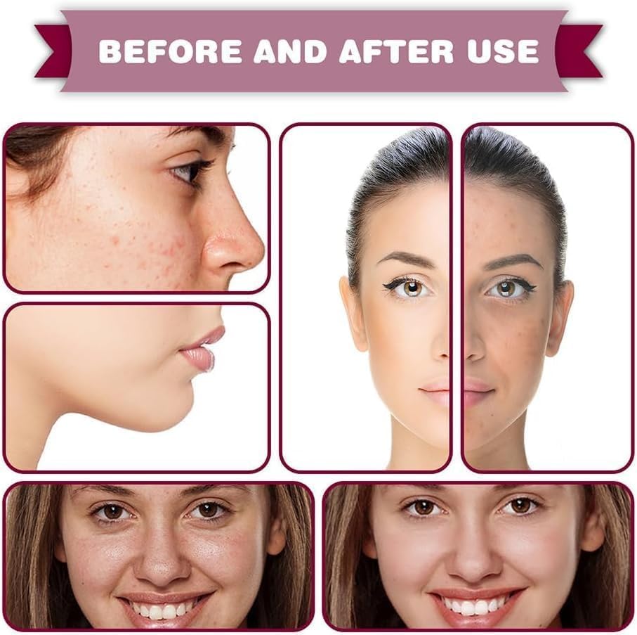 Tratamiento Facial para Rosácea 5pcs - Sérum de Ácido de Frutas para Reducir Rojeces y Equilibrar Sebo - 30ml