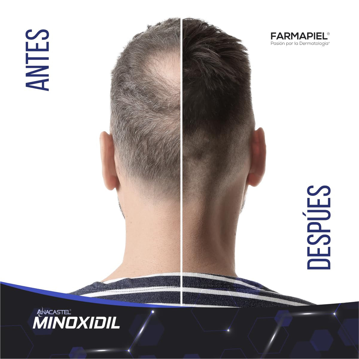 Spray Anticaída Anacastel Minoxidil 5% 2 Pack