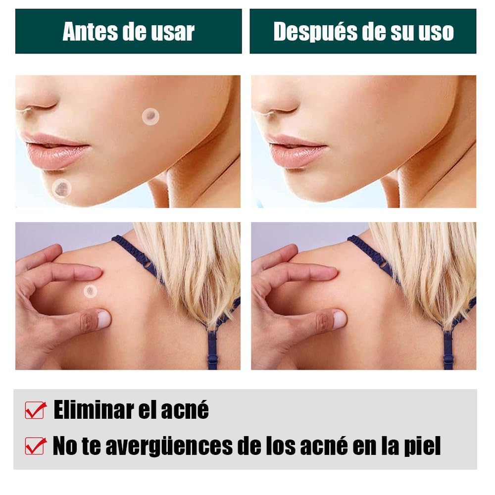 Parches de Piel Hidrocoloides para Acné - Tratamiento Absorbente para Espinillas en la Cara - Pack de 180 Calcomanías Ultra Finas - Cuidado Profesional para la Piel - Absorben Secreciones para una Piel Más Sana y Limpia