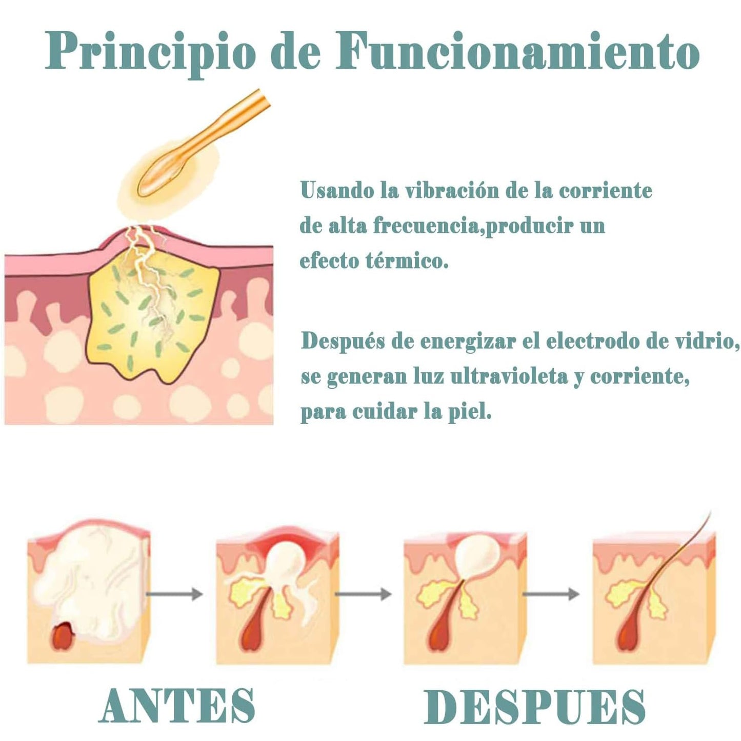 Alta Frecuencia Facial, Radiofrecuencia Facial para Estiramiento de La Piel Que Elimina el Acné. Portable Handheld Aparato de Radiofrecuencia Facial, Alta Frecuencia. Maquinas Faciales de Alta Frecuencia para Quitar Arrugas, Acné con 4 Electrodos (Luz nar