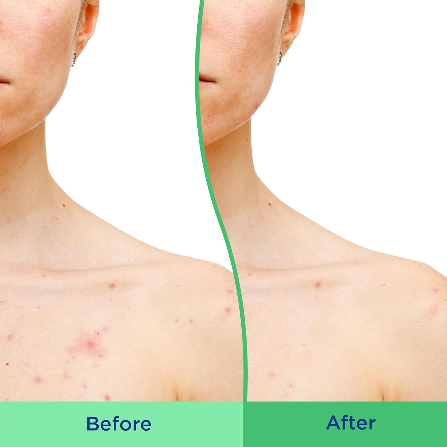 Differin Body Scrub with Salicylic Acid Acne Clearing Improves Tone and Texture Prone Skin on Back Shoulders and Chest, 8 Oz